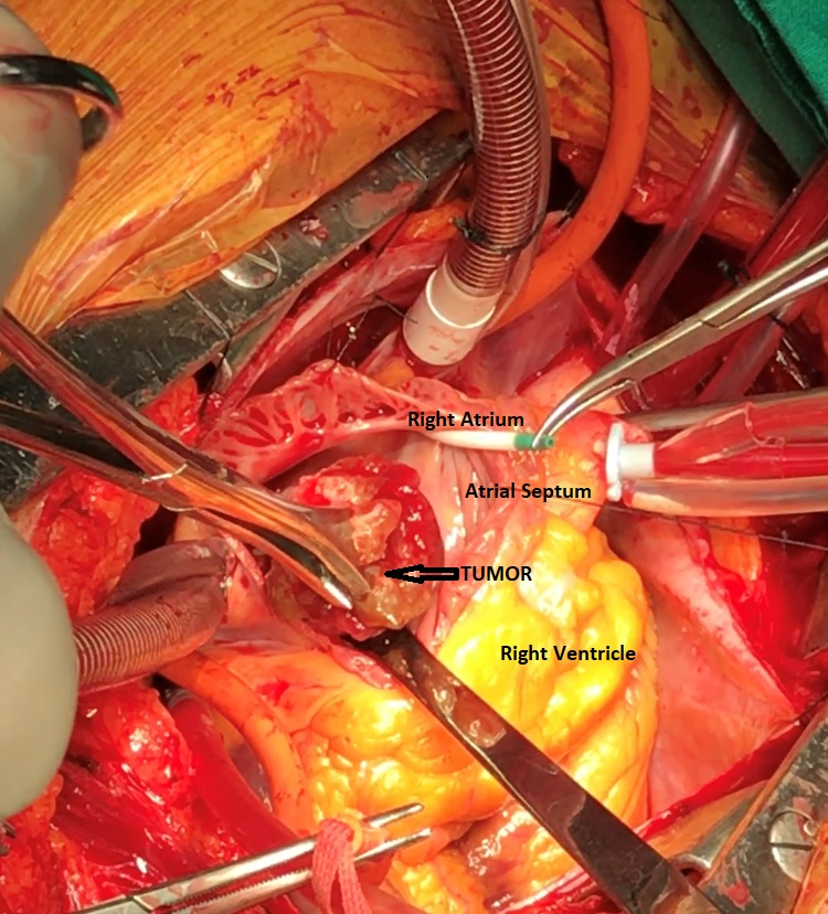 Heart Surgery For Primary Cardiac Tumor Left Atrial Myxoma